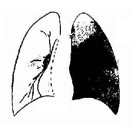 左侧大量胸腔积液