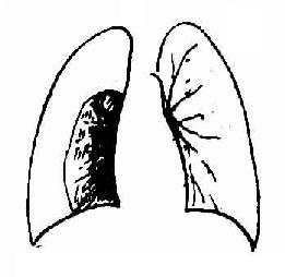 右侧气胸,右肺被压缩