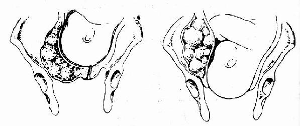 宫颈浆膜下肌瘤,随宫颈口的展平开大,向上退出盆腔,不影响分娩